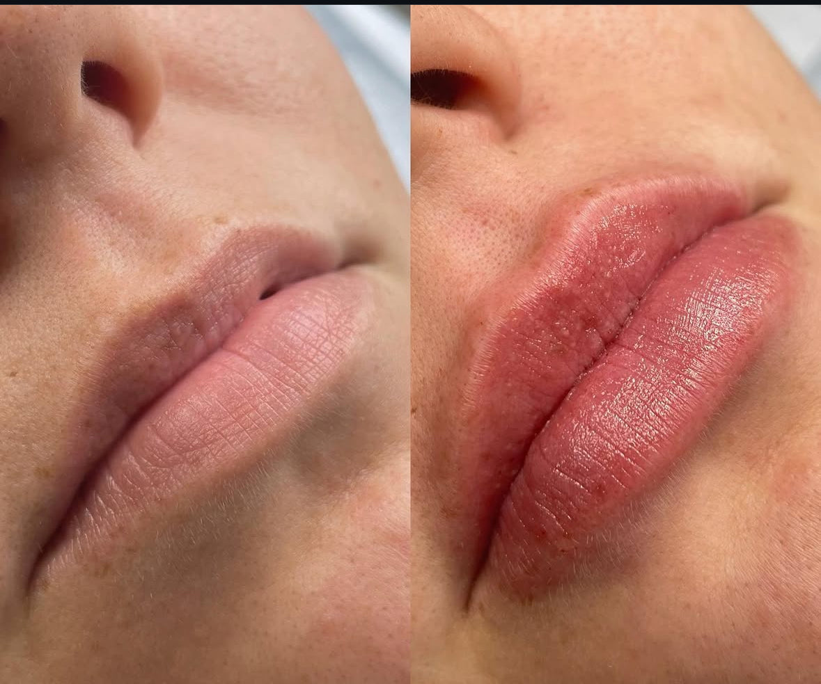 Volume Lips