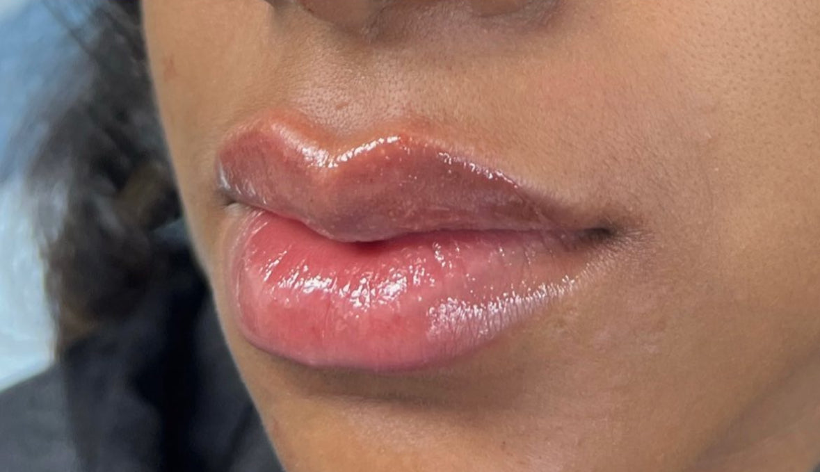 Volume Lips