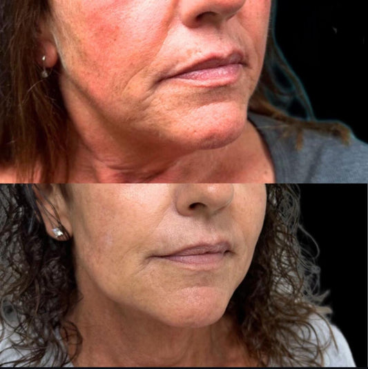 Full Facial Balancing