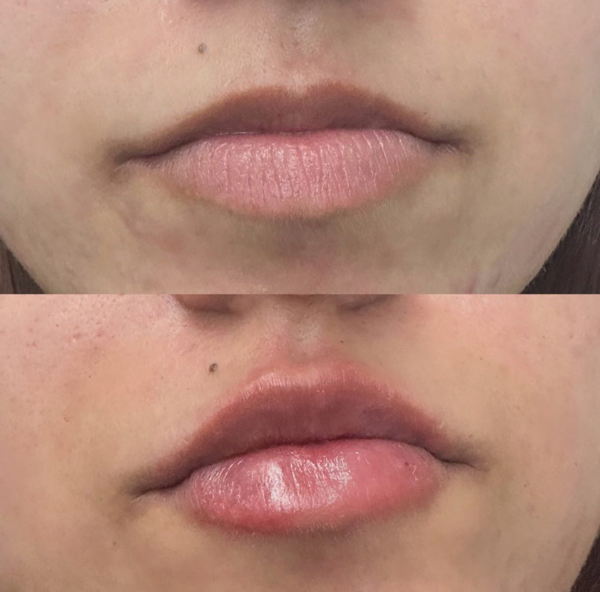 Volume Lips